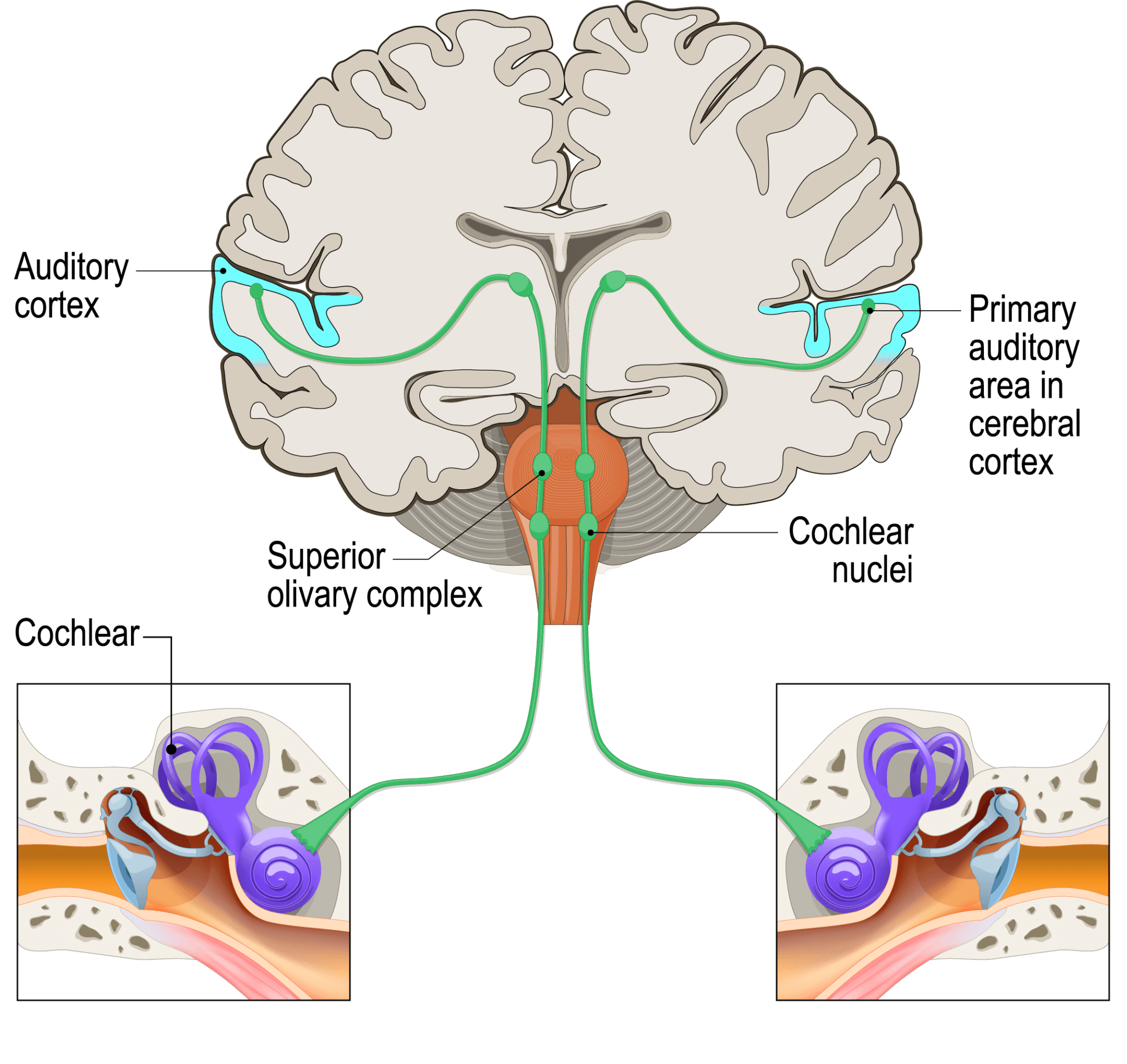 auditory cortex damage